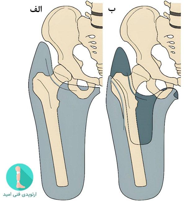 سوکت پوششی ایسکیال پروتز بالای زانو