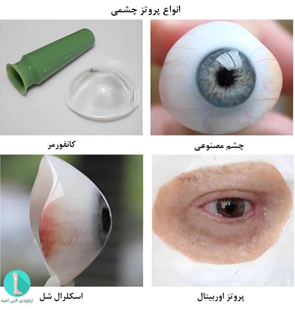 انواع چشم مصنوعی