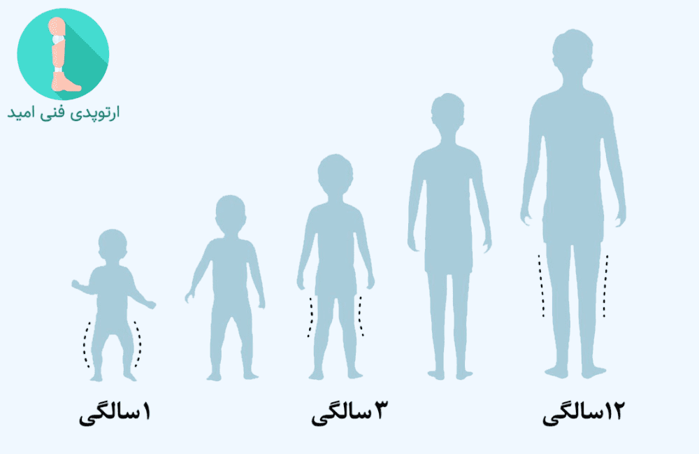 بهترین زمان درمان پای پرانتزی