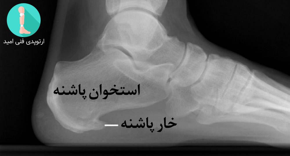 تأثیر کفی و کفش طبی در کنترل علائم و درمان خارپاشنه