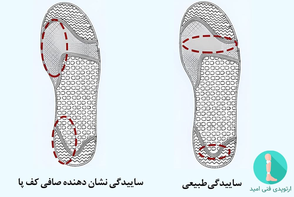 مشاهده الگوی ساییدگی کف کفش برای تشخیص کف پای صاف