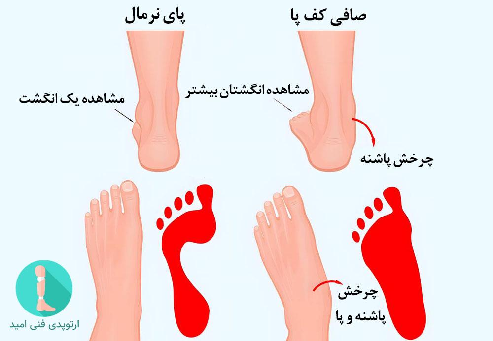 تشخیص صافی کف پا با مشاهده تعداد انگشتان پای فرد از پشت