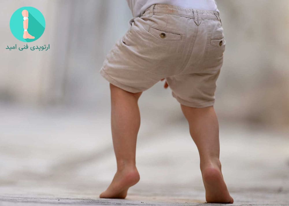 راه‌رفتن روی پنجه پا می‌تواند به دلیل مشکلات عضلانی یا عصبی ایجاد شود.