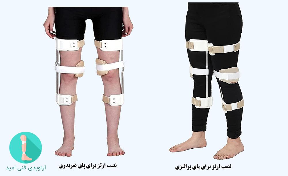 درمان انحراف زانو با ارتز
