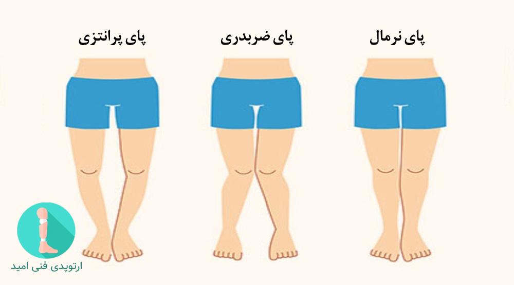 انحراف زانو به داخل یا خارج و درمان آن