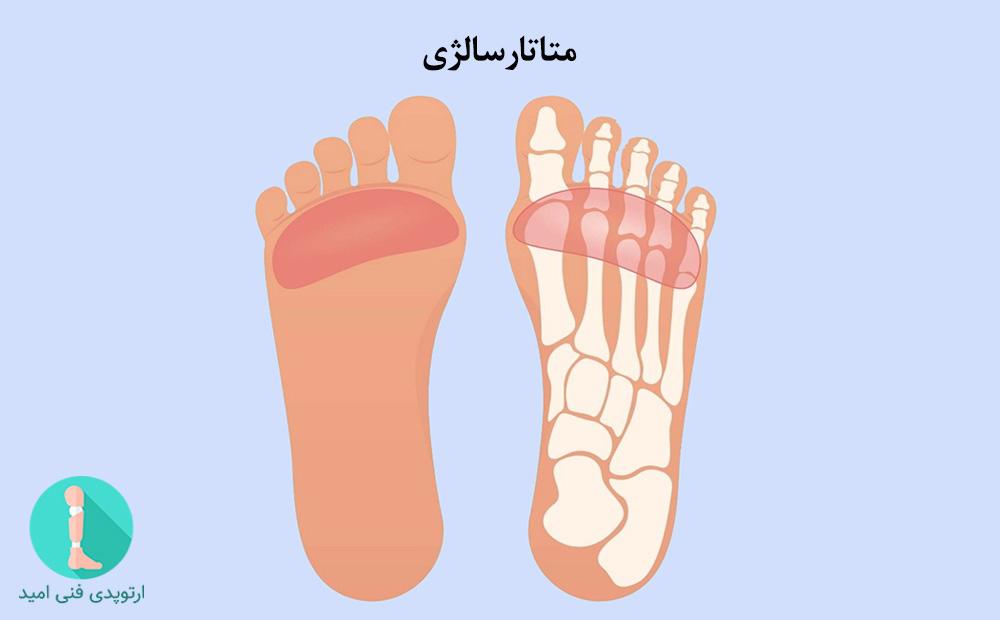 متاتارسالژی