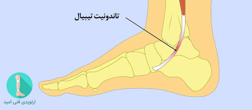 تاندونیت تیبیال