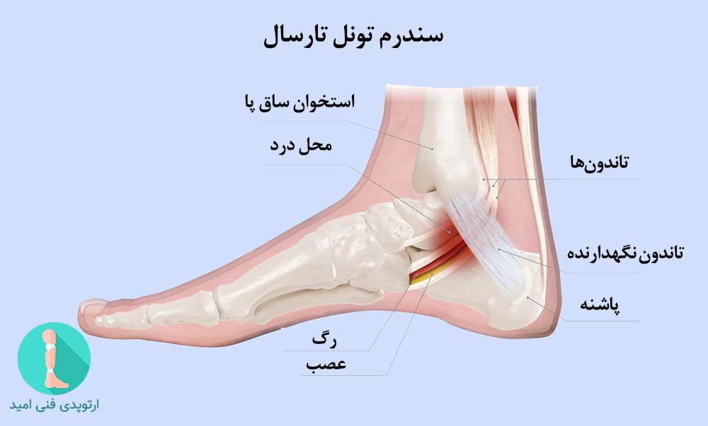 سندروم تونل تارسال 