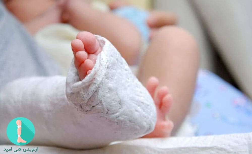 کلاب فوت یا پاچنبری یک مشکل مادرزادی است