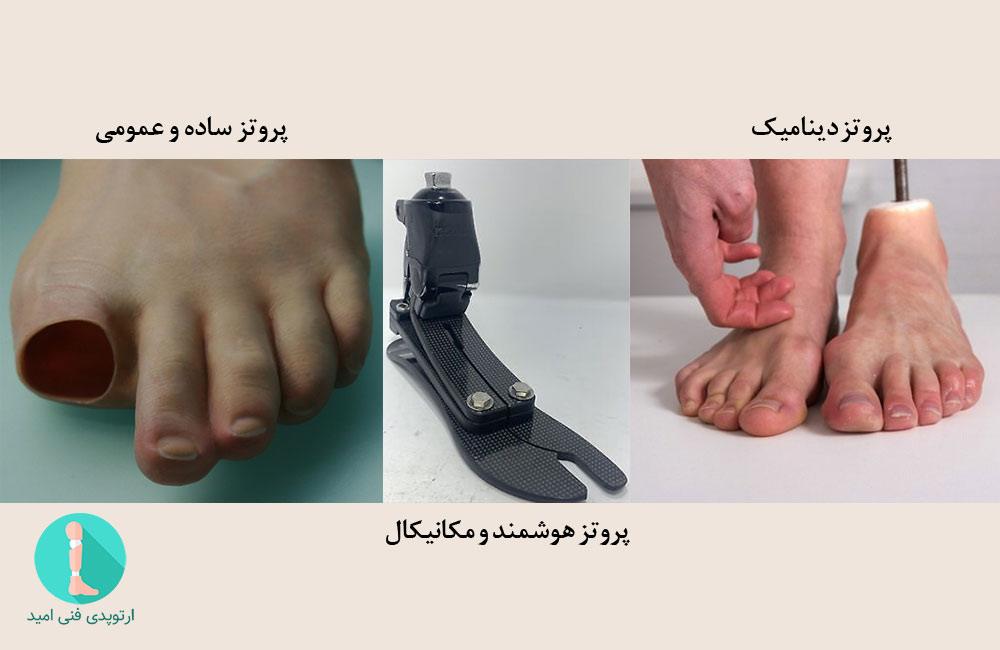 پروتز مناسب انگشت پا