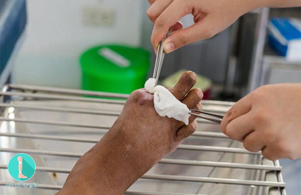 مراقبت از پوست ناحیه ی قطع عضو