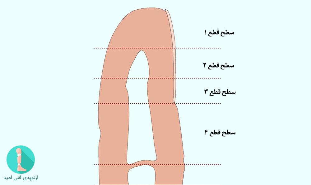 سطوح رایج قطع انگشت دست