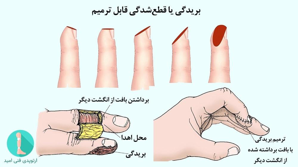 بریدگی یا قطع شدگی قابل ترمیم