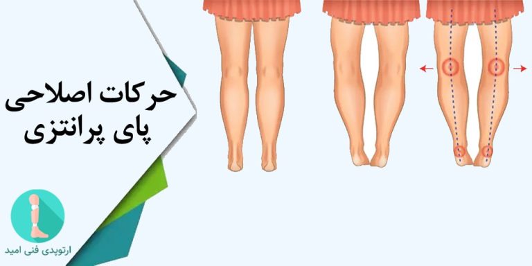 حرکات اصلاحی پای پرانتزی