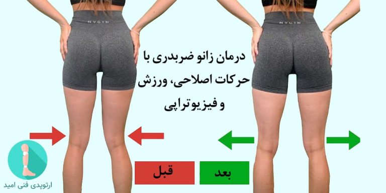 درمان زانو ضربدری